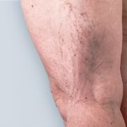 Bacaklardaki Kılcal Damarların Tedavisi - Dr. Şerafettin Saraçoğlu | Nişantaşı Dermatolog