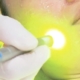 Dual Yellow Laser - Dr. Şerafettin Saraçoğlu | Nişantaşı Dermatolog