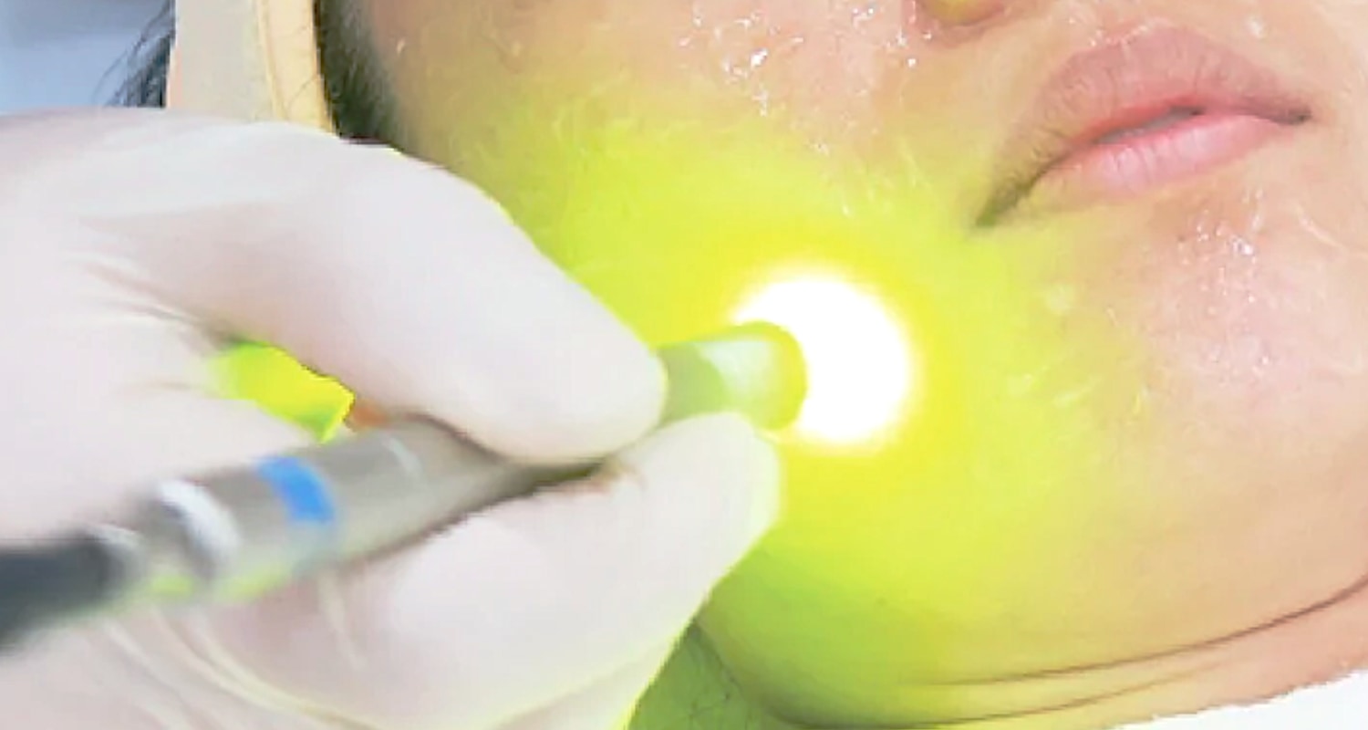 Dual Yellow Laser - Dr. Şerafettin Saraçoğlu | Nişantaşı Dermatolog
